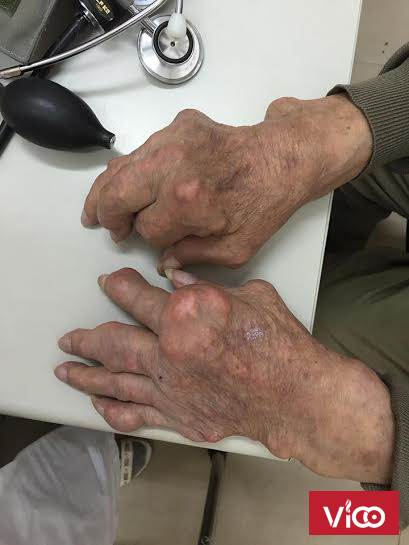 Bệnh Gout và nỗi lo sợ kinh hoàng