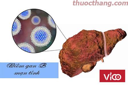 6 Dấu hiệu cảnh báo bệnh viêm gan B Mạn Tính