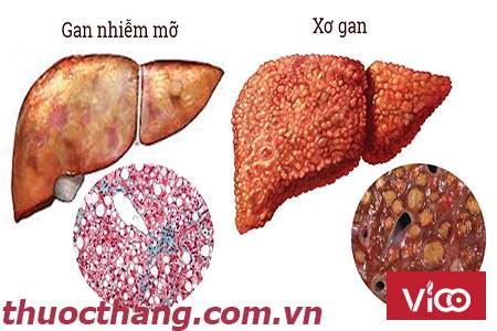 Gan nhiễm mỡ có nguy cơ gây ung thư gan.