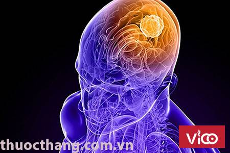 Triệu chứng của bệnh ung thư não theo từng giai đoạn.