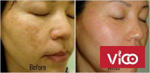 Kinh nghiệm trị nám hiệu quả chị em cần biết